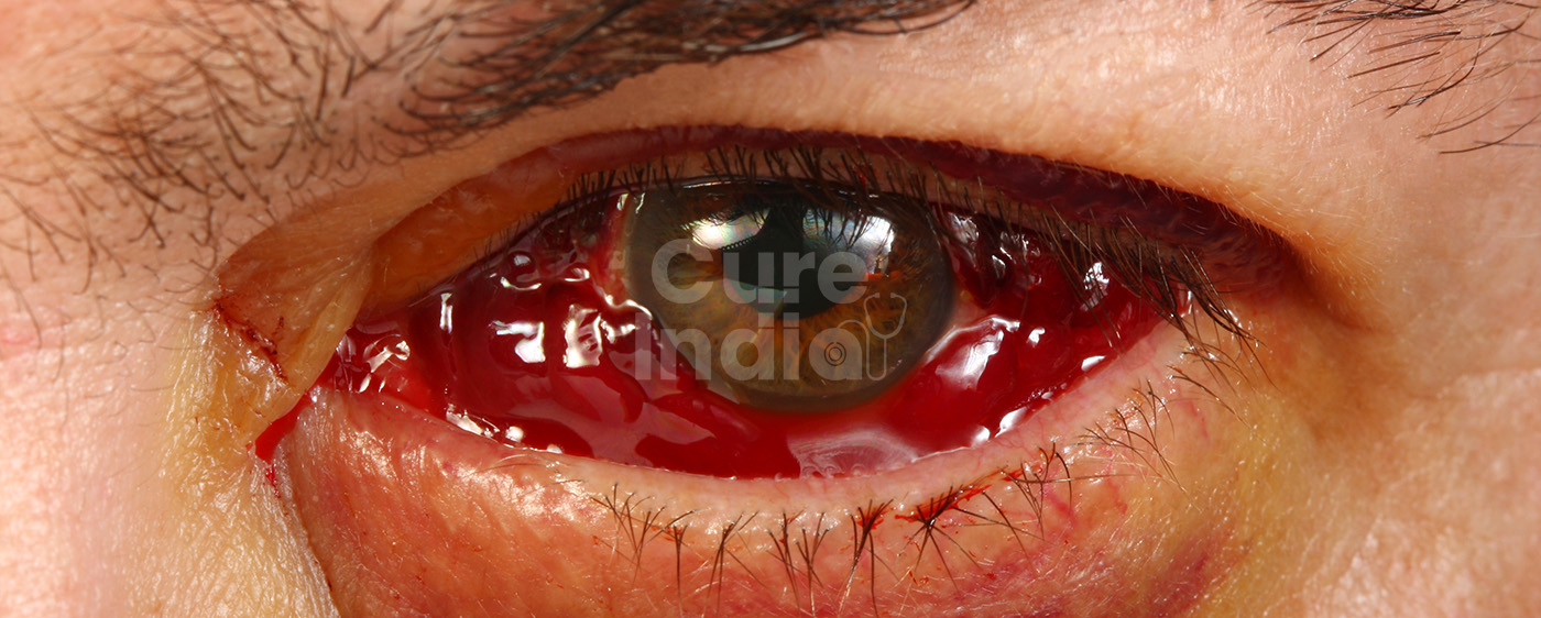 Vitreo Retinal Surgery